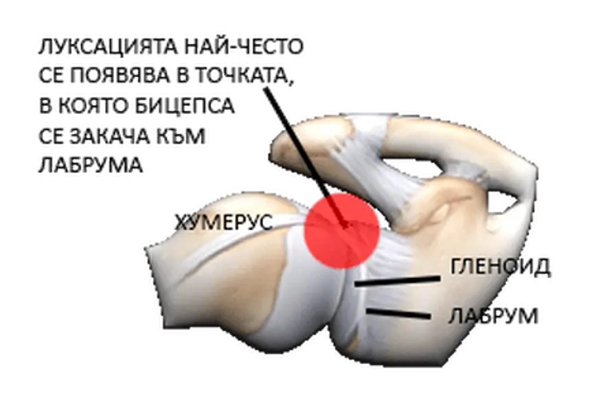 болка в рамото - луксация